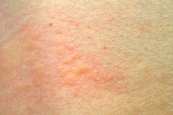 db256ff1f833c7b45a57f2e28a7398af.png 荨麻疹是不是过敏