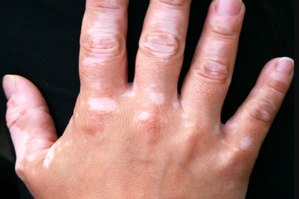 0b5b0885ad6400c80eaef6c30a0f2a04.png 白癜风初期表现是什么