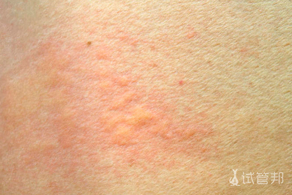 1d619808f0dd6f3d4ef79be28f95f877.png 荨麻疹怎么引起的