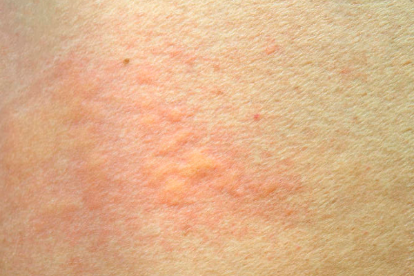 38c22fdc91a863cdbbb4b793d43ce47d.png 荨麻疹反复发作是怎么回事/