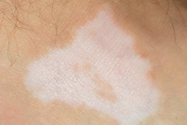 66bc7f2250820c0e56d50ba280cb3e63.png 白癜风早期症状有哪些