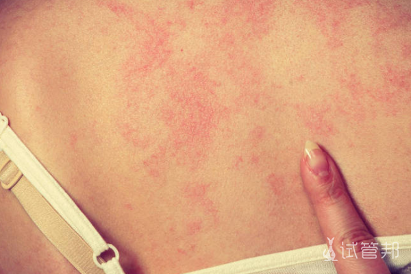963af9814692d32dca35ac71ef46e057.png 荨麻疹可以自愈吗