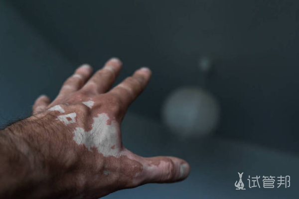 ad105e29e795848cb059eb3ef8a0860b.png 白癜风扩散速度快不快