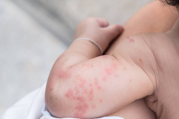 d397dd2797543262825c138be33e2d30.png 荨麻疹需要做什么检查