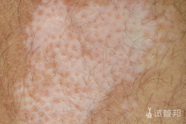 df299bad1d353f58f92fc055510004a4.png 白癜风需要做什么检查