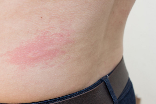 f7873b7ad77d23078c02bec8a49d2ac7.png 荨麻疹症状表现有哪些