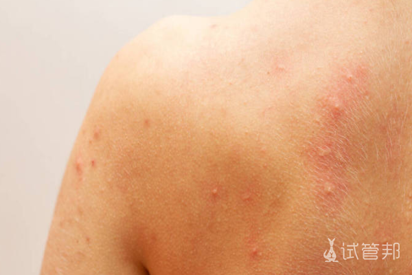 f8fbe8062586f98effecc3c488cf5fd7.png 荨麻疹皮肤病有什么症状