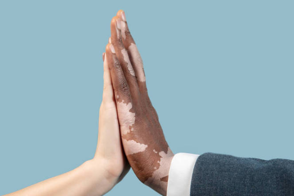 049ae1efc7ebb7cb1547aa8a95f9e273.png 白癜风发病机制有哪些