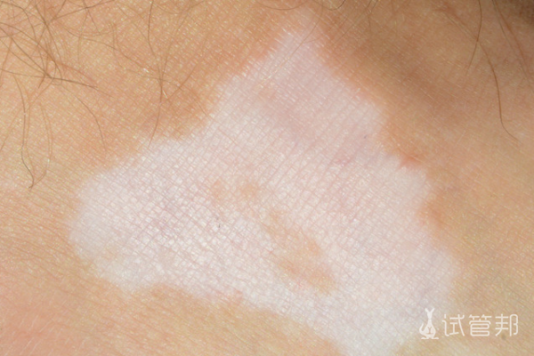 12a28d341cf5ed97f97a8758c71a6311.png 白癜风的白斑会不会自己消失