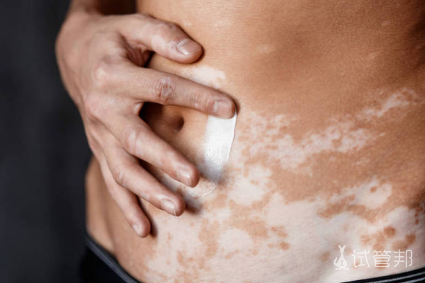 3e6053db11bbb46b0cd9d1fd634a211d.png 白癜风表现有哪些