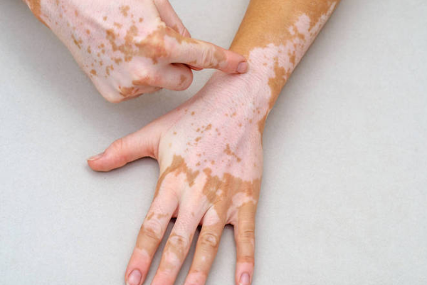 3ea13dd41a731ba456ca4045ecd41e4a.png 白癜风治疗多少钱