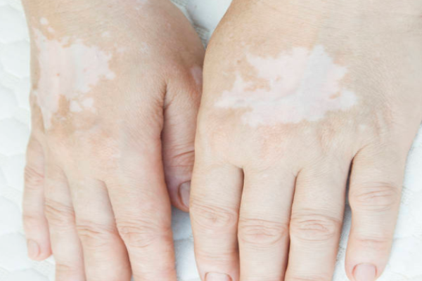 4f252d67f0e0aa89c8f286482430b480.png 得了白癜风该怎么办