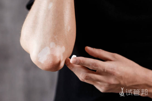 5b18eddd6df155ae708e70ccbcb6aa41.png 白癜风发展快不快