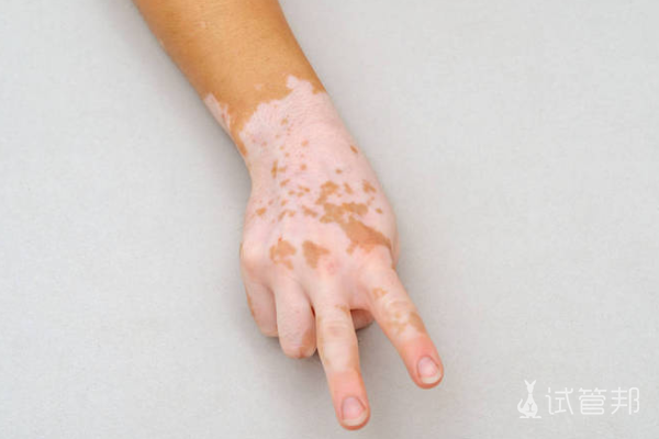 68eb9a3cfc067aebb886cfb03c312a53.png 白癜风挂什么科