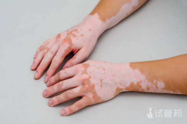 6edfb168fcb93855147ab2f2fa316118.png 白癫风由什么引起的