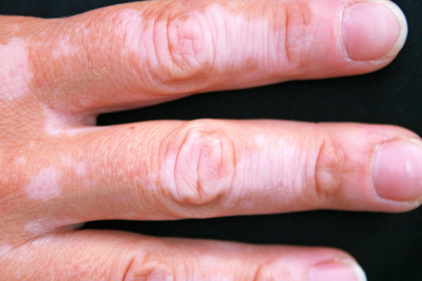 7202624d6f6e9354f20c9d0bdf65b829.png 白癜风会遗传给小孩吗