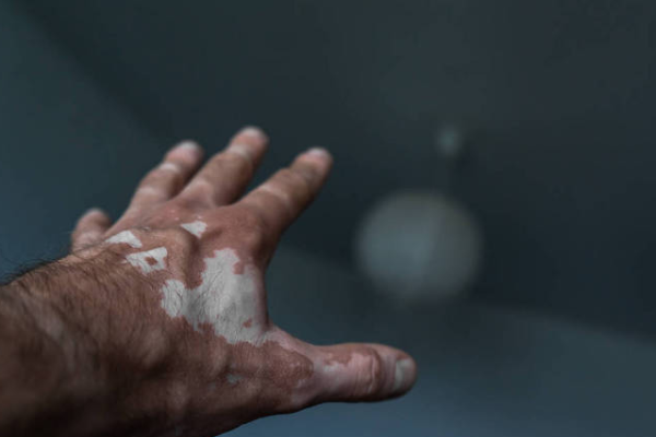 7d476d228cc0ec65f0e2e41c5f9b1974.png 白癜风会扩散到全身吗