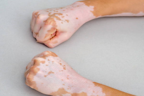 8eeaa2469052aeae4ce208c636fe1e8d.png 白癜风多久会扩散