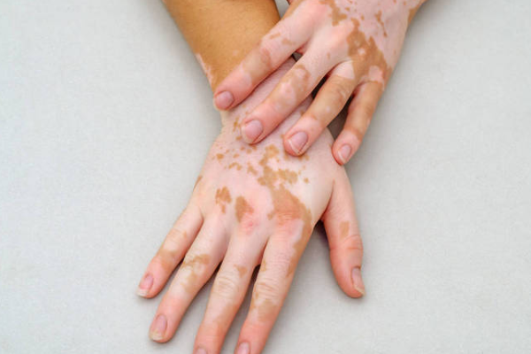 b71debf2d3ebe2a0134f376503d9d4f3.png 白癫风治疗方法有哪些