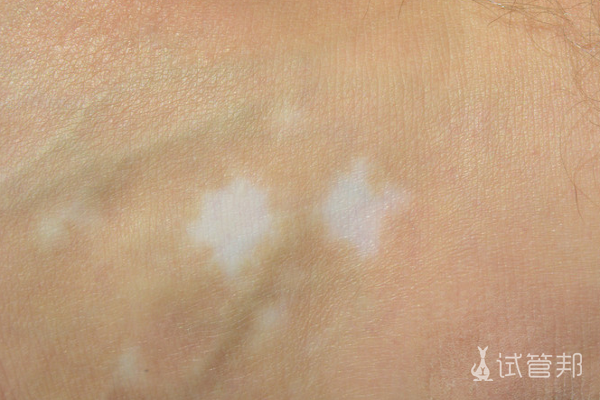 c3a837c2e4df758d14ca98cc507004cb.png 白癜风会不会传染