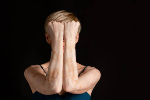 d9295972db520c77ac114c8c5c56f77a.png 白癜风和白斑一样吗