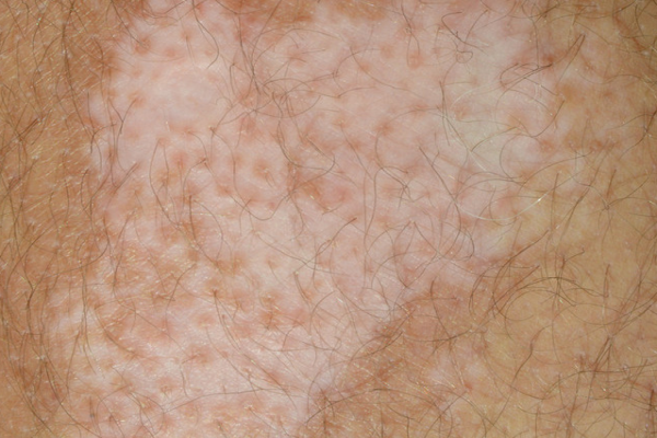 e0b576cfad498e20881a2cf418d01b43.png 白癜风治疗方法有哪些