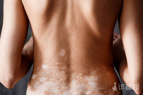 e2134cad15bf3498ef97bd694128d380.png 白癜风对生活有影响吗