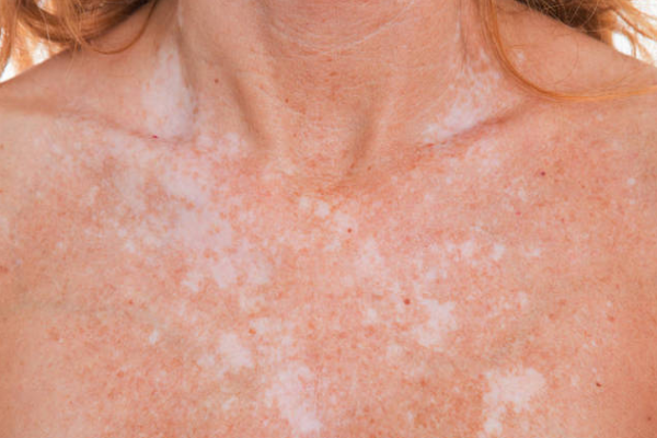 e7668195c5f49227f95802193fe8e37e.png 白癜风需要住院治疗吗