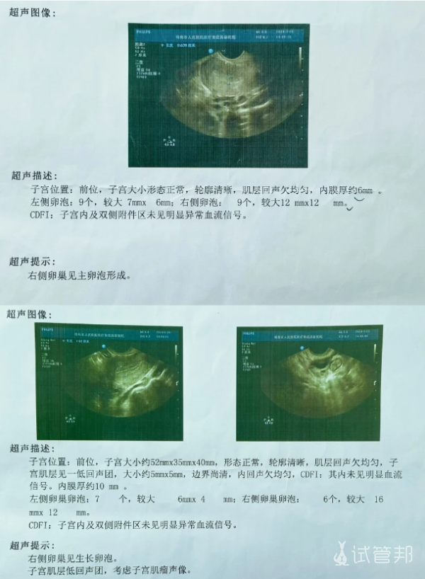 18767be4ece33196b6e3cca13faacd9a.png 卵泡监测记录