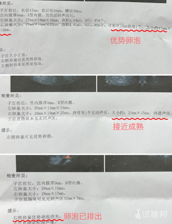 d3725fee798d5ccf923ceaa3caf7a15f.png 第—次卵泡监测的注意事项分享