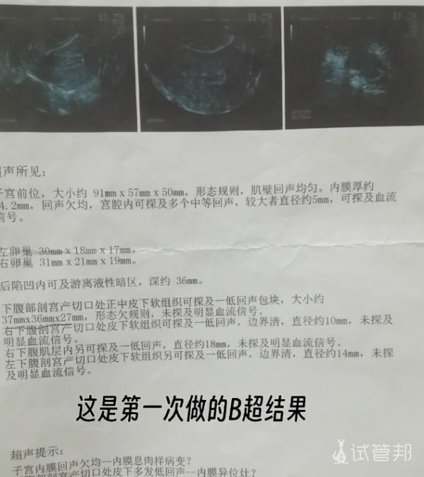 64b0d733dfd10f758dcfbd0d69f6eb0b.png 子宫内膜异位症保守治疗我的选择对吗