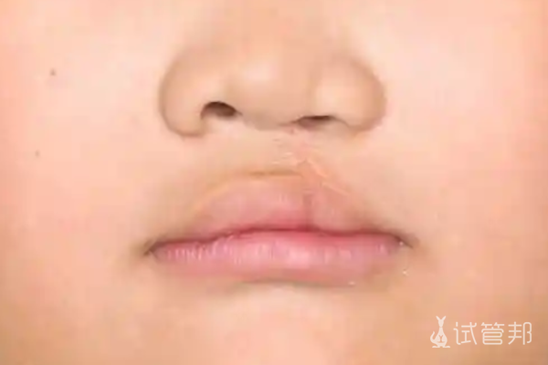 0a12706eceb529e7067cb805f8476245.png 兔唇会影响说话吗