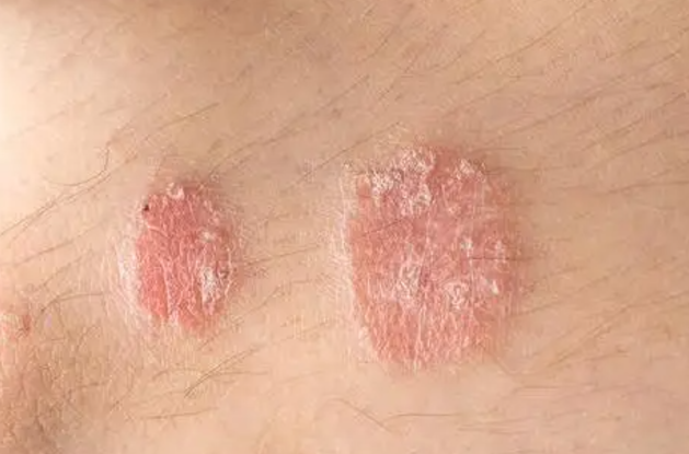 0a24ebde49416ac1470e0c69bab5f531.png 牛皮癣传染吗