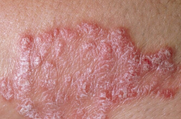 1d143cfa12dcef1c8d0fc04163700dad.png 牛皮癣应该如何预防