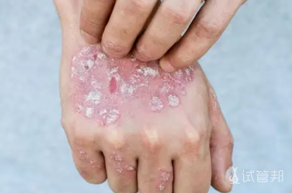 1f833736051ae64e4b02a615ffd2a42a.png 男性牛皮癣影响生育吗