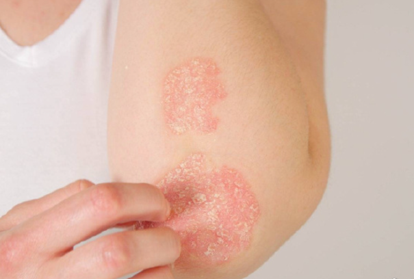 283b2f3124fa4051211f0c83a0de4566.png 上海治疗牛皮癣需要多少钱