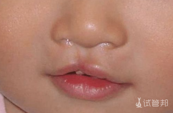 2fe158db3cfdc5eb81fa298db287e382.png 兔唇的遗传几率有多大