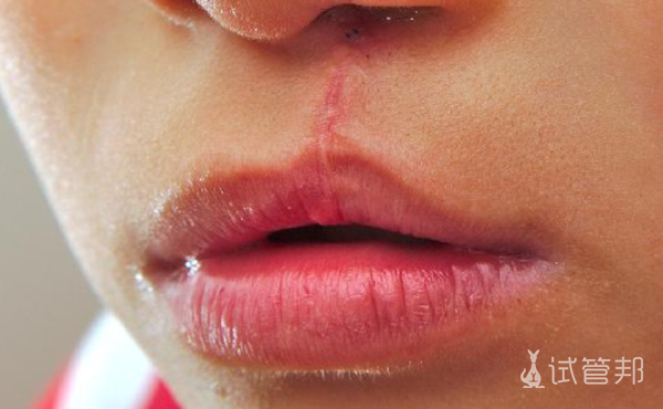 42c30b09c5b5a14738cb215be306ed71.png 成人兔唇整形需要多少钱