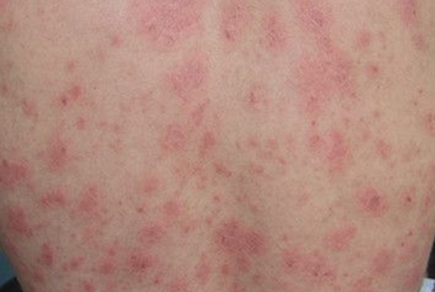 45fb311961fceb6f09a910d5430c3a47.png 上海牛皮癣医院有哪些