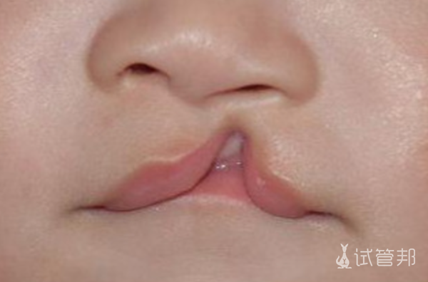 5b290506223a85dcf08c9fc4a381d666.png 兔唇是什么原因造成的