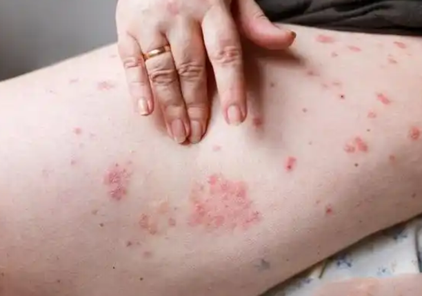 5e98759dcf9b5aac0a912e213537464f.png 牛皮癣怎么治