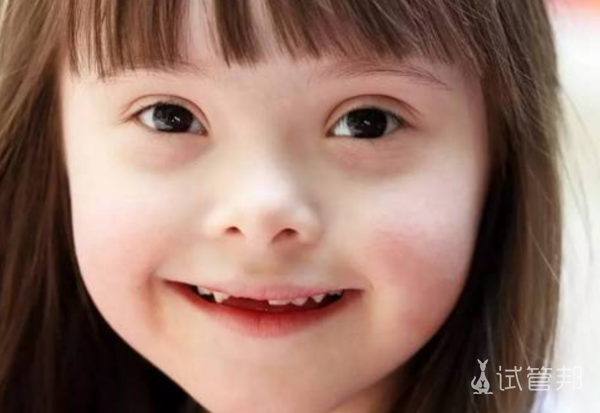 5f816128d85d9601fa4accba3433bd04.png 天使综合征长得很漂亮吗