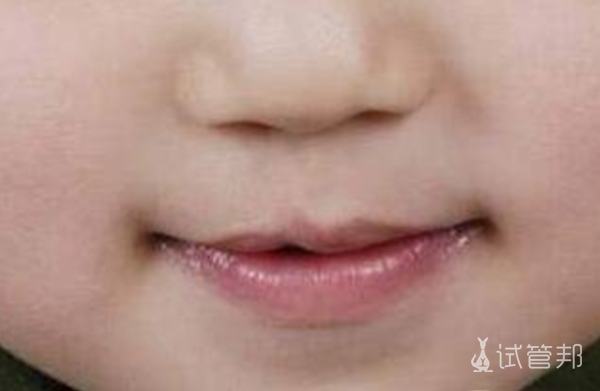 6c22e567151174804ae0fea9aec2dea9.png 儿童兔唇手术一般多少钱