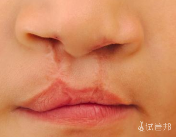 6f275668113273747be434de2a482334.png 兔唇图片