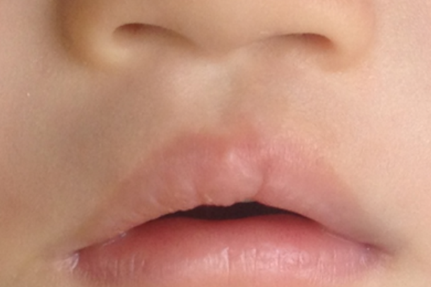 70b6b6f36be4d5b151300604e6d50b10.png 兔唇是什么原因造成的