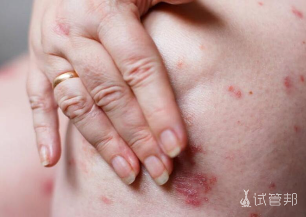 9d1daeaa9844d07c029090b1e572e4b3.png 牛皮癣图片什么样