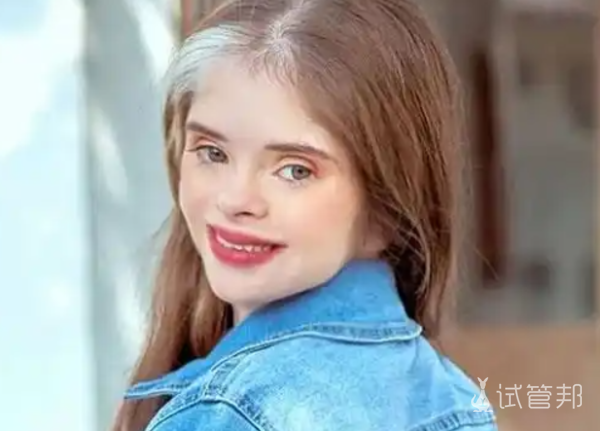 a582209935ce32b66e3aa230796bec1f.png 天使综合征能恢复到什么程度