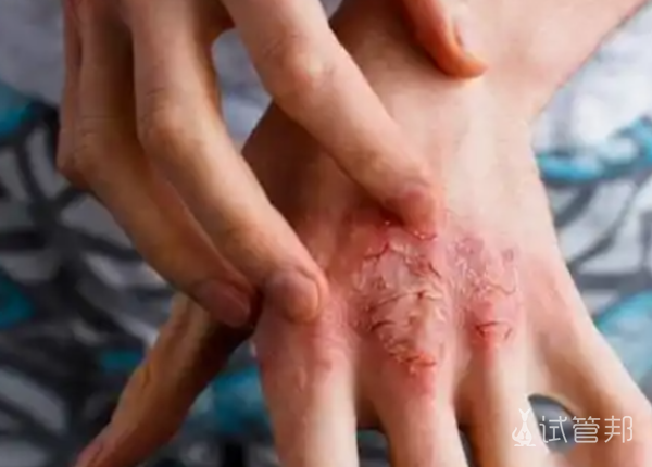 b12490439a88921547826467cd490130.png 牛皮癣的预防方法有哪些