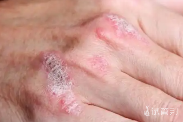 be459c0398c6d179582d4365df59be7d.png 牛皮癣的病因是什么