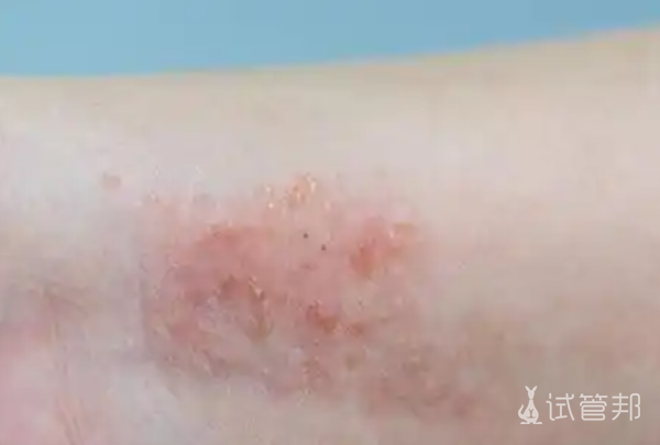 cc16822c22b2f0b3eca2ea6adf522d27.png 牛皮癣的症状表现有哪些